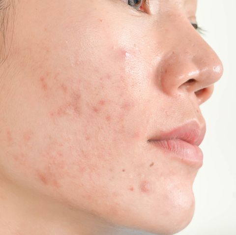 Fights Acne