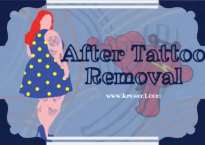 After Tattoo Removal